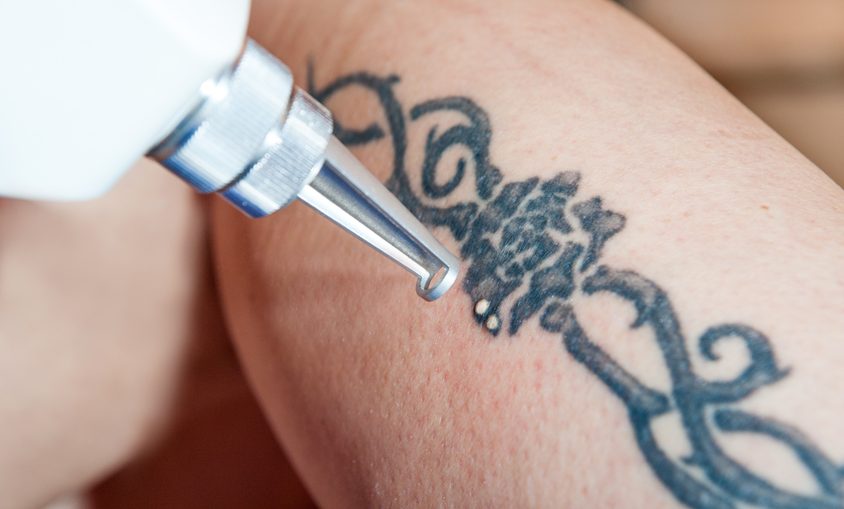 Laserowe usuwanie tatuażu 